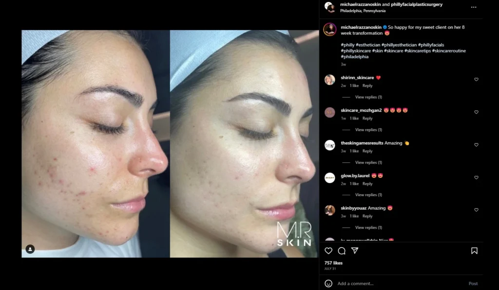 before and after social media marketing for estheticians